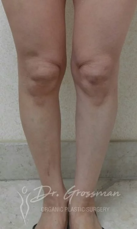 calf augmentation with fat