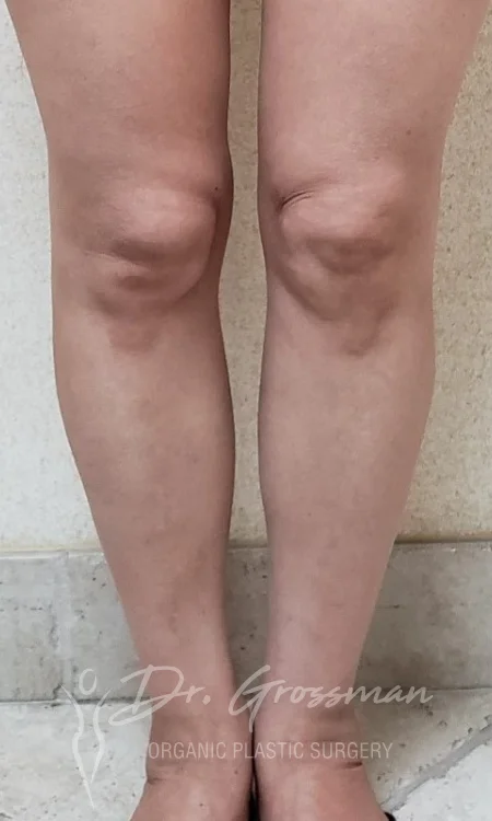 calf augmentation with fat