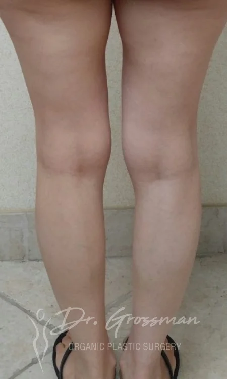 calf augmentation with fat
