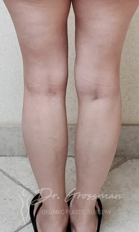 calf augmentation with fat