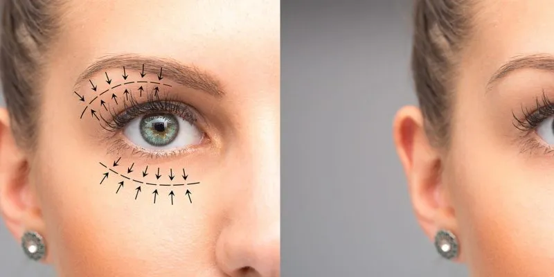 calf augmentation with fat