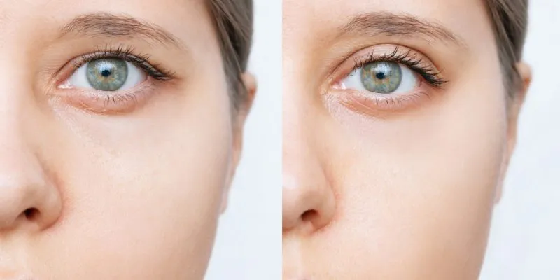 calf augmentation with fat